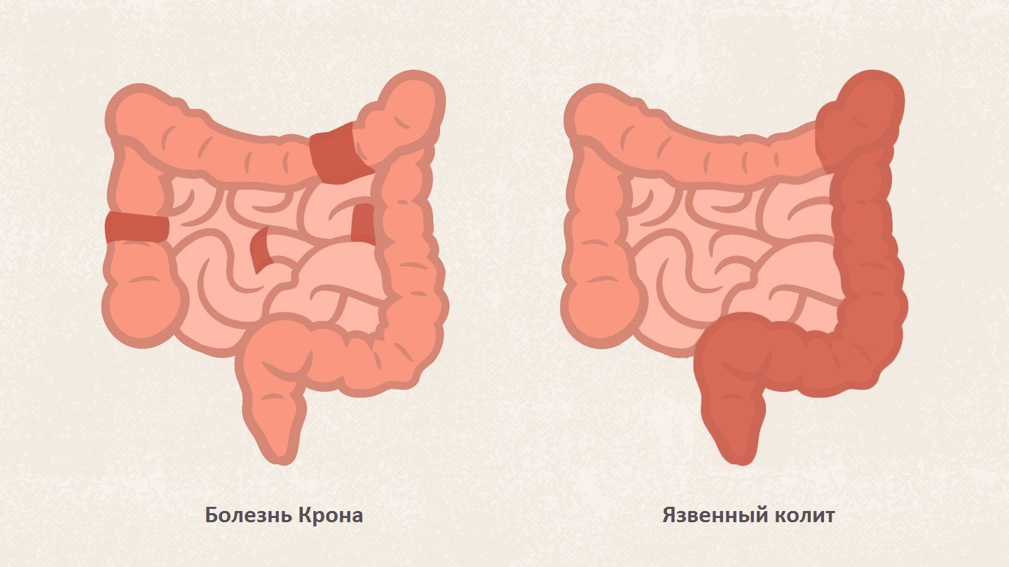 Болезнь крона стол 4